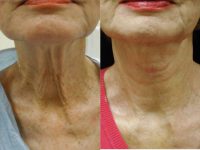 55-64 year old woman treated with Laser Treatment