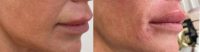 55-64 year old woman treated with Injectable Fillers for a NonsurgicalLip Lift