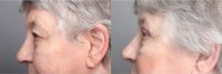 55-64 year old woman treated with Eyelid Surgery (Upper Blepharoplasty)