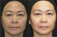 55-64 year old woman treated with Microneedling