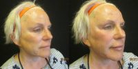 55-64 year old woman treated with Sculptra Aesthetic