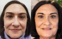 62 year old woman treated with Injectable Fillers