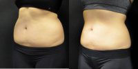 55-64 year old woman treated with CoolSculpting