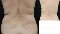 55-64 year old woman treated with Liposuction
