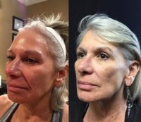 55-64 year old woman treated with Microdermabrasion