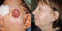 55-64 year old woman treated with Skin Cancer Reconstruction