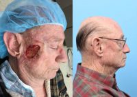 65-74 year old man treated with Facial Reconstructive Surgery