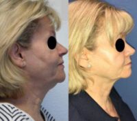 68 year old woman treated with Profound RF and 2 syringes of Voluma to the cheeks
