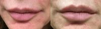 65-74 year old woman treated with Lip Augmentation