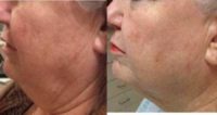 65-74 year old woman treated with Kybella