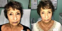 65-74 year old woman treated with Skin Tightening