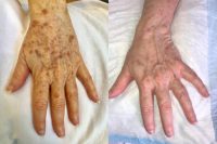 65-74 year old woman treated with BroadBand Light (BBL)