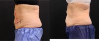65-74 year old woman treated with CoolSculpting & Vanquish