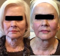 65-74 year old woman treated with NovaThreads