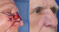 75 and up year old man treated with Skin Cancer Reconstruction after Mohs Surgery
