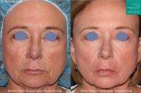 75 and up year old woman treated with Laser Resurfacing
