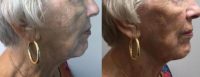 75 and up year old woman treated with Voluma