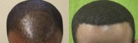 Afro-Textured FUE Hair Transplant Procedure