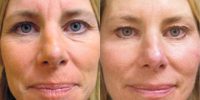 Anti-Aging Alteration with Sculptra and Botox