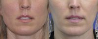 Botox for Jawline Reduction and Teeth Grinding