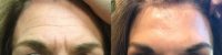 Botox for 11's: Frown Lines and Forehead Wrinkles