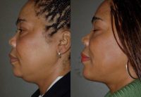 Chin Surgery, Chin Augmentation, Double Chin