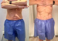 CoolSculpting for men: belly fat and love handles