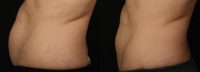 CoolSculpting Female Abdomen and Flanks