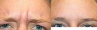 38 year old woman treated with Botox