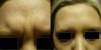 35-44 year old woman treated with Botox for frown lines