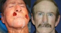 65-74 year old man treated with Facial Reconstructive Surgery