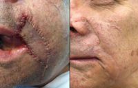 65-74 year old man treated with Mohs Surgery
