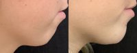 18-24 year old woman treated with Chin Fillers