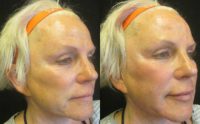 55-64 year old woman treated with Liquid Facelift
