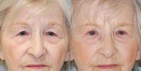 Blepharoplasty: 65-74 year old woman
