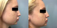 Non-Surgical Rhinoplasty with Juvederm