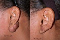 Woman with earlobe keloid scar