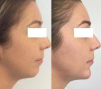 Woman treated with Chin Filler Using Voluma and Radiesse