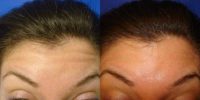 29 year old female treated with Botox the forehead