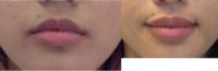 25 year old woman treated with Lip Augmentation