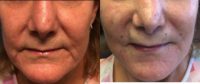 55-64 year old woman treated with Bellafill