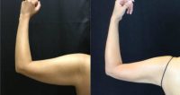 25-34 year old woman treated with BodyTite of the arms.