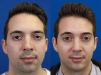 25-34 year old man treated with Chin Implant for microgenia and revision rhinoplasty
