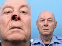55-64 year old man treated with Facial Reconstructive Surgery