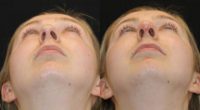 18-24 year old man treated with Nonsurgical Nose Job