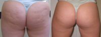 Thermage for Cellulite
