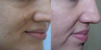 InMode Fractora for acne scarring and discoloration on cheeks
