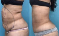 35-44 year old woman treated with Laser Liposuction