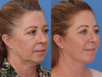 Facelift and lower eyelid surgery