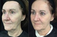 55-64 year old woman treated with Silhouette InstaLift and Juvederm Voluma
